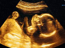 Fetus ultrasound at 24 weeks